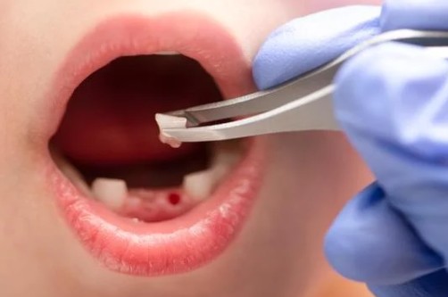 Tooth Extraction