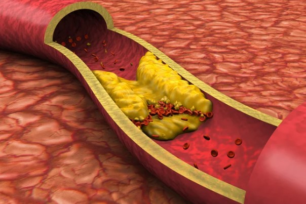 Cholesterol Management