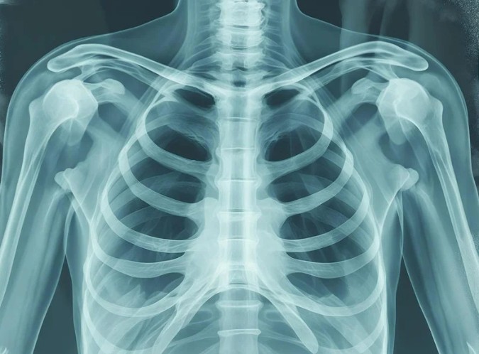 Chest X-Ray